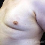 Gynecomastia Before & After Patient #2317