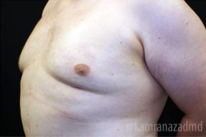 Gynecomastia Before & After Patient #2317
