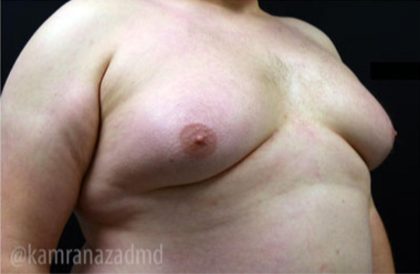 Gynecomastia Before & After Patient #2317