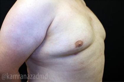 Gynecomastia Before & After Patient #2317