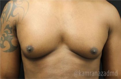 Gynecomastia Before & After Patient #2319