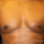 Gynecomastia Before & After Patient #2319
