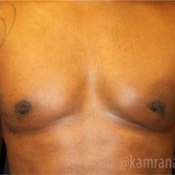 Gynecomastia Before & After Patient #2319