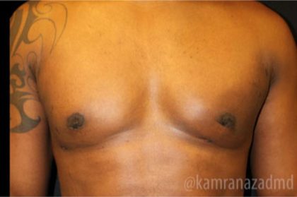 Gynecomastia Before & After Patient #2319