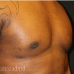 Gynecomastia Before & After Patient #2319