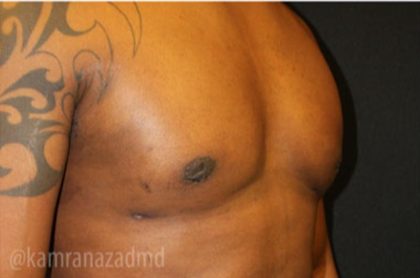 Gynecomastia Before & After Patient #2319
