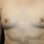 Gynecomastia Before & After Patient #2321