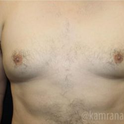 Gynecomastia Before & After Patient #2321