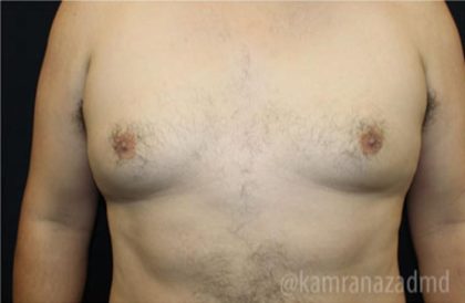 Gynecomastia Before & After Patient #2321