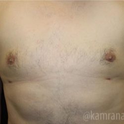 Gynecomastia Before & After Patient #2321