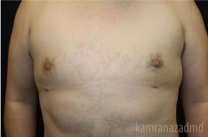 Gynecomastia Before & After Patient #2321