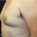 Gynecomastia Before & After Patient #2321