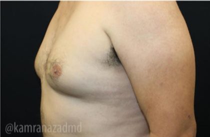 Gynecomastia Before & After Patient #2321