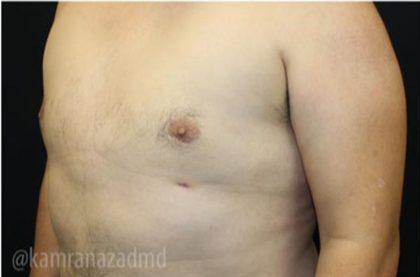 Gynecomastia Before & After Patient #2321