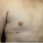 Gynecomastia Before & After Patient #2321