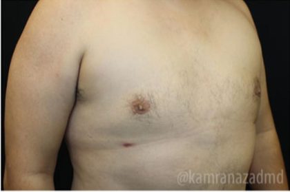 Gynecomastia Before & After Patient #2321