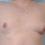 Gynecomastia Before & After Patient #2322