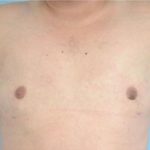 Gynecomastia Before & After Patient #2322