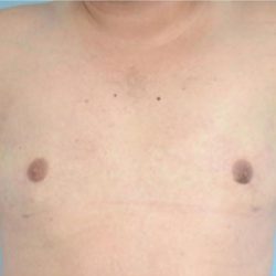 Gynecomastia Before & After Patient #2322
