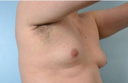 Gynecomastia Before & After Patient #2322