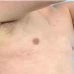Gynecomastia Before & After Patient #2322