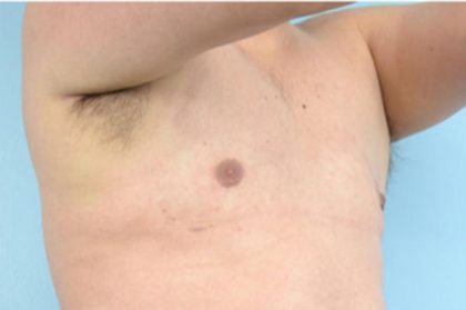 Gynecomastia Before & After Patient #2322