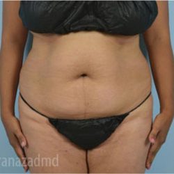 Liposuction Before & After Patient #2881