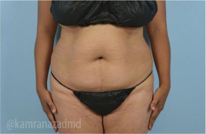 Liposuction Before & After Patient #2881
