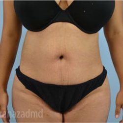 Liposuction Before & After Patient #2881