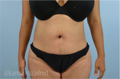 Liposuction Before & After Patient #2881