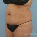 Liposuction Before & After Patient #2881