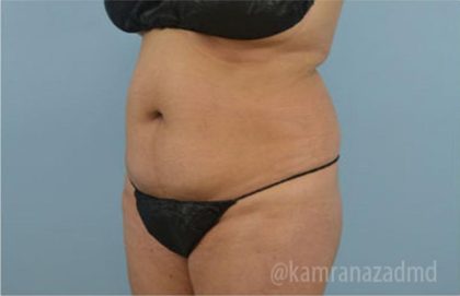 Liposuction Before & After Patient #2881