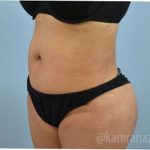 Liposuction Before & After Patient #2881