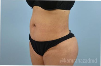 Liposuction Before & After Patient #2881