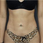 Liposuction Before & After Patient #2882