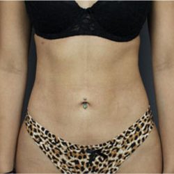 Liposuction Before & After Patient #2882