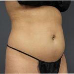 Liposuction Before & After Patient #2882
