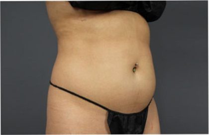 Liposuction Before & After Patient #2882