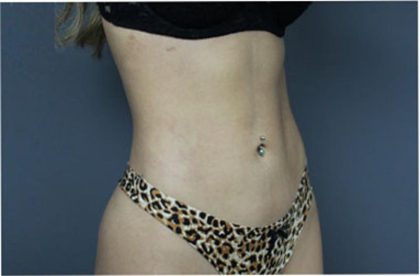 Liposuction Before & After Patient #2882