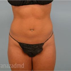 Liposuction Before & After Patient #2884