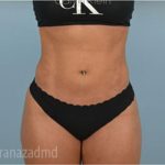 Liposuction Before & After Patient #2884