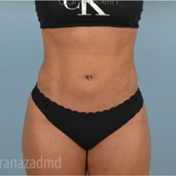 Liposuction Before & After Patient #2884