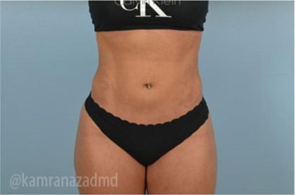 Liposuction Before & After Patient #2884