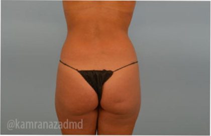 Liposuction Before & After Patient #2884