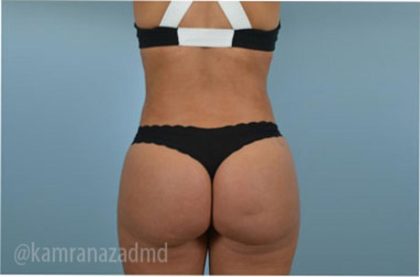 Liposuction Before & After Patient #2884
