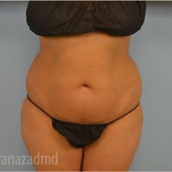 Liposuction Before & After Patient #2885