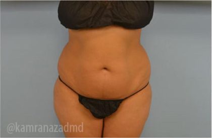 Liposuction Before & After Patient #2885