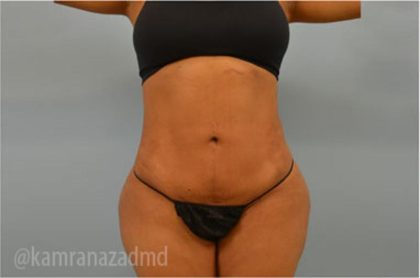 Liposuction Before & After Patient #2885