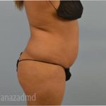 Liposuction Before & After Patient #2885