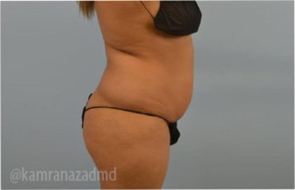 Liposuction Before & After Patient #2885
